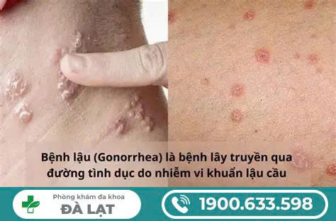 DẤU HIỆU VÀ TRIỆU CHỨNG CỦA BỆNH LẬU – CÁCH NHẬN BIẾT SỚM ĐỂ ĐIỀU TRỊ KỊP THỜI
