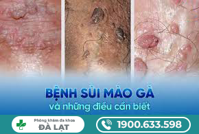 TỔNG QUAN VỀ BỆNH SÙI MÀO GÀ
