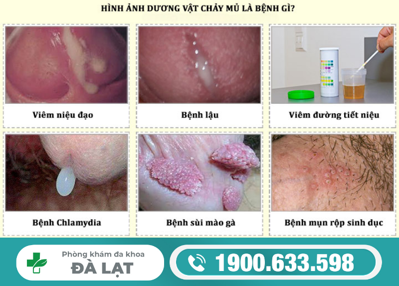 DƯƠNG VẬT CHẢY DỊCH VÀNG