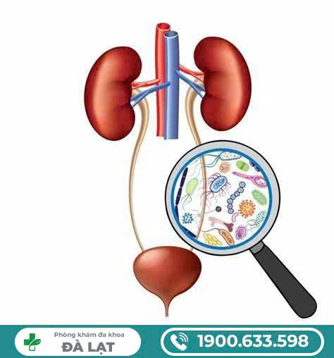 VIÊM ĐƯỜNG TIẾT NIỆU CHẢY MỦ – DẤU HIỆU CẢNH BÁO NHIỄM TRÙNG NẶNG