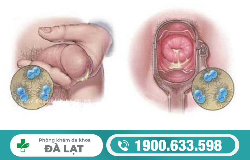 DẤU HIỆU VÀ TRIỆU CHỨNG BỆNH LẬU: CÁCH NHẬN BIẾT SỚM ĐỂ TRÁNH BIẾN CHỨNG