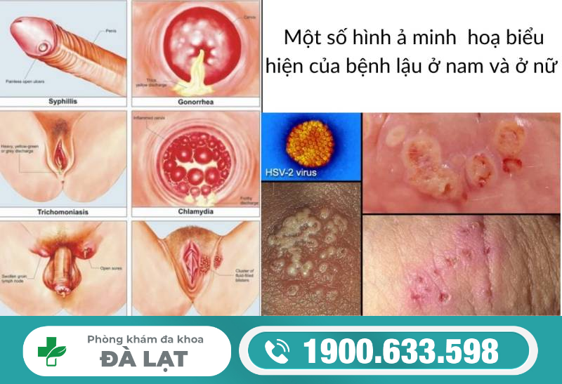 TÌM HIỂU CÁC GIAI ĐOẠN CỦA BỆNH LẬU