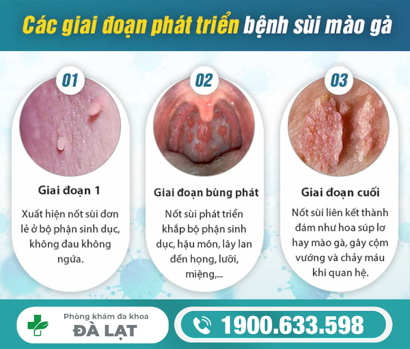 NHẬN DIỆN BỆNH SÙI MÀO GÀ QUA CÁC GIAI ĐOẠN PHÁT TRIỂN