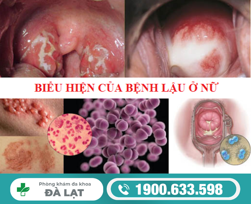 BỆNH LẬU Ở NỮ CÓ NGUY HIỂM KHÔNG?