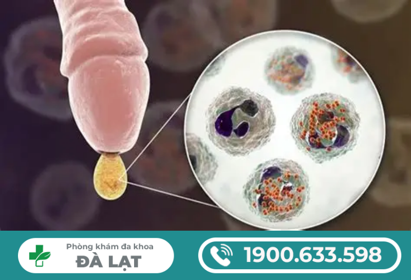 CHẢY MỦ SAU KHI QUAN HỆ LÀ BỊ GÌ?