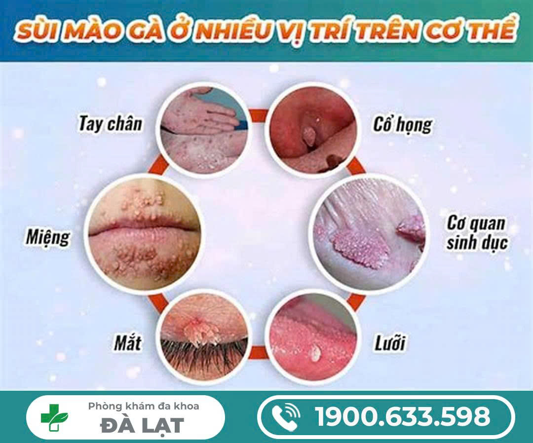 CÁC VỊ TRÍ ĐIỂN HÌNH SÙI MÀO GÀ HAY XUẤT HIỆN