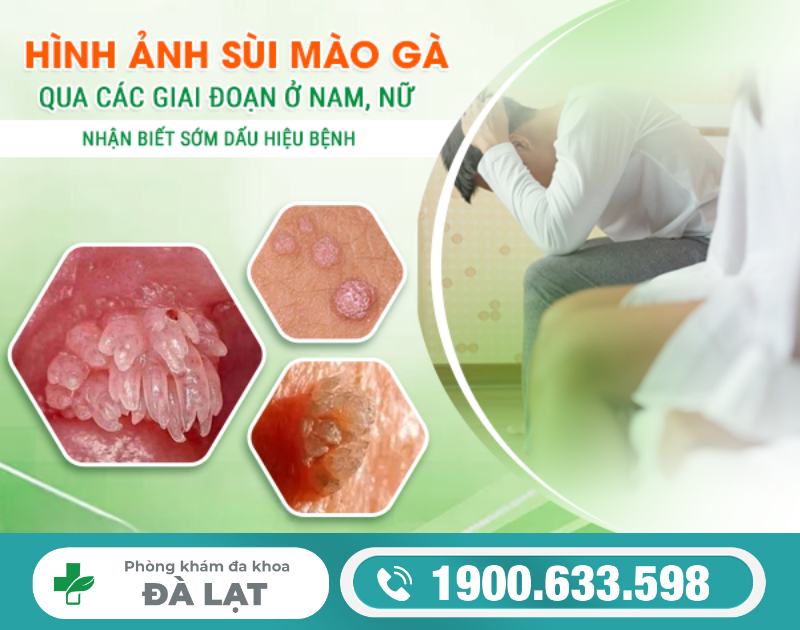 HÌNH ẢNH SÙI MÀO GÀ QUA CÁC GIAI ĐOẠN Ở NAM VÀ NỮ GIỚI