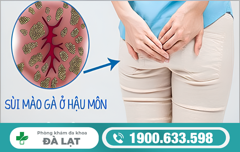 SÙI MÀO GÀ Ở HẬU MÔN CÓ BIỂU HIỆN GÌ?