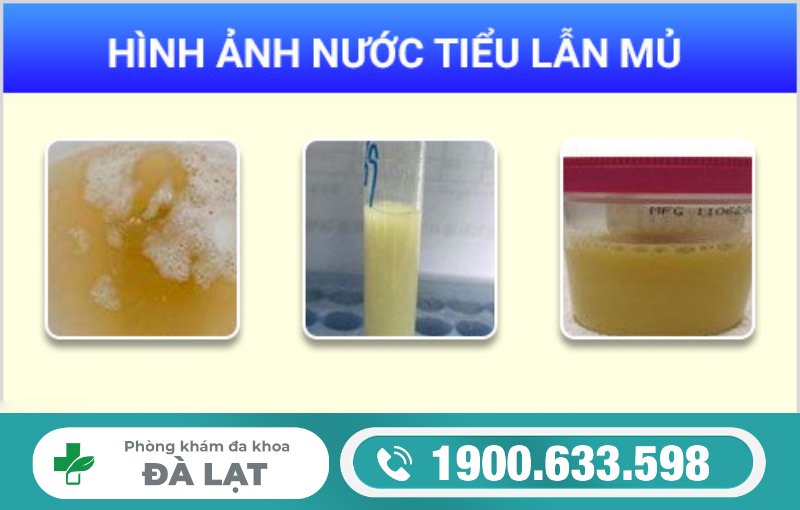 ĐI TIỂU BUỐT CÓ MỦ VÀNG LÀ DẤU HIỆU CẢNH BÁO BỆNH GÌ