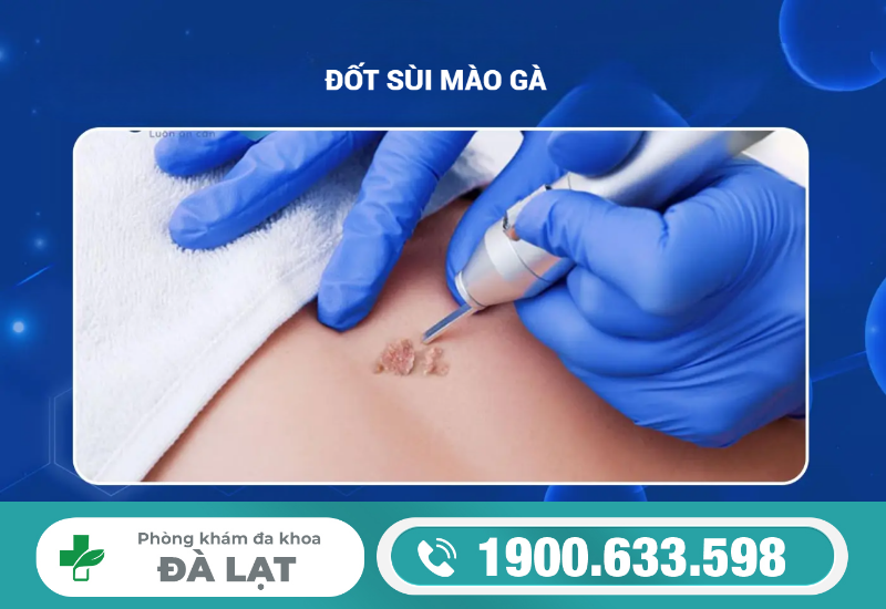 NGUY CƠ GÌ XẢY RA NẾU SÙI MÀO GÀ KHÔNG ĐƯỢC CHỮA TRỊ?