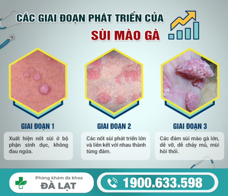 SỰ PHÁT TRIỂN CỦA BỆNH SÙI MÀO GÀ