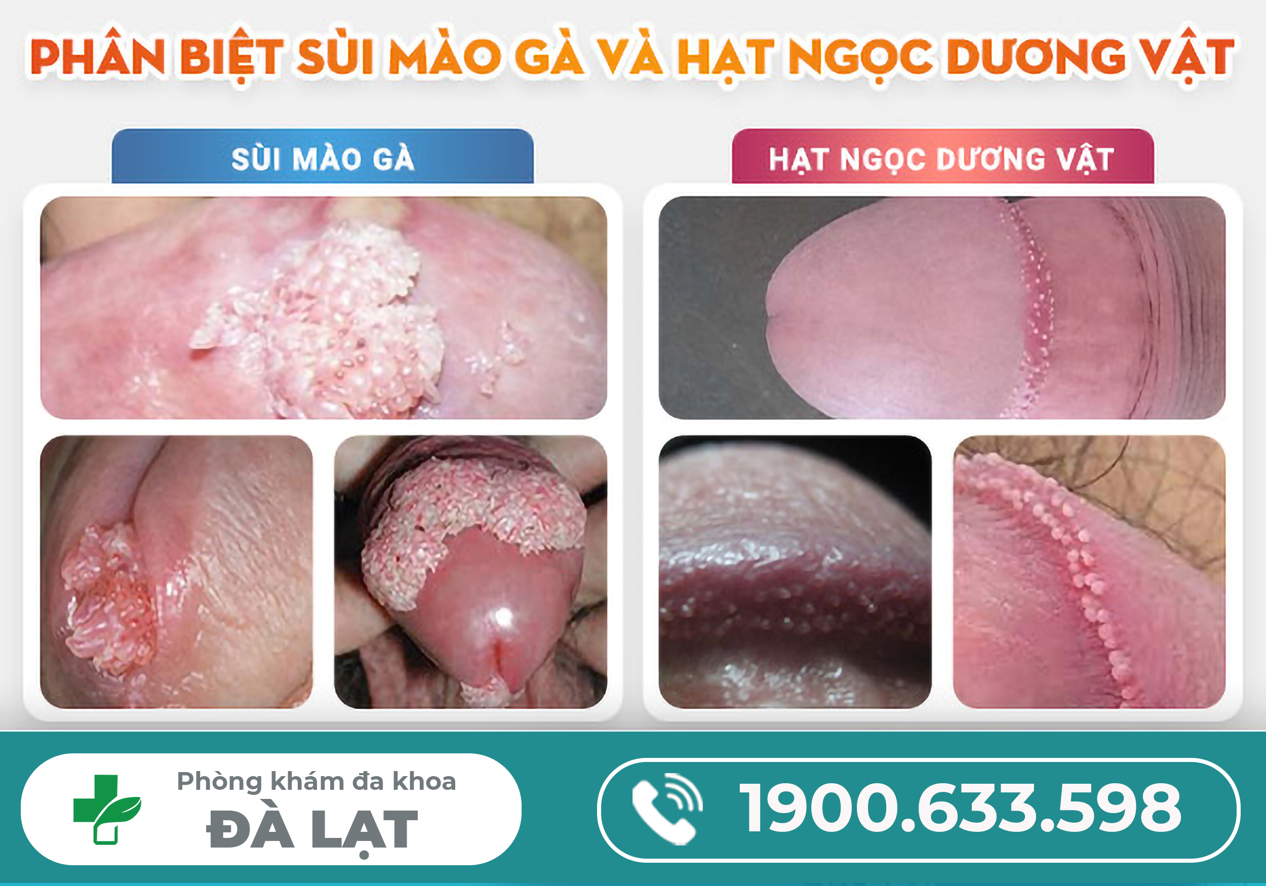 SÙI MÀO GÀ KHÁC GÌ HẠT NGỌC DƯƠNG VẬT? DẤU HIỆU NHẬN BIẾT
