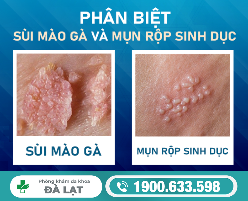 MỤN RỘP SINH DỤC CÓ GIỐNG SÙI MÀO GÀ KHÔNG? CÁCH NHẬN BIẾT ĐÚNG