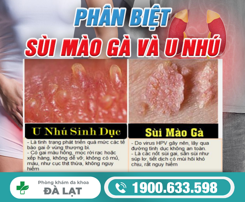 NHẬN BIẾT SÙI MÀO GÀ, U NHÚ VÀ U MỀM LÂY ĐỂ TRÁNH CHẨN ĐOÁN NHẦM