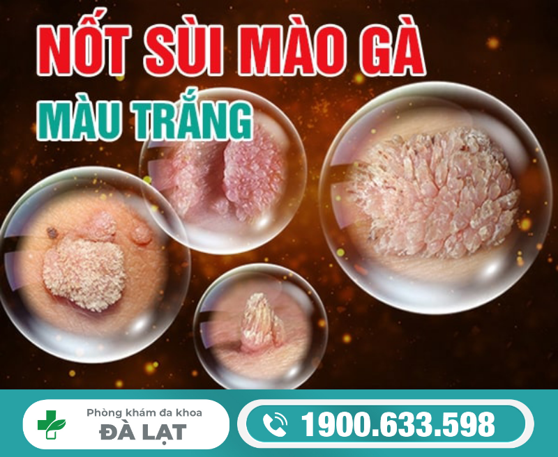 CÁCH NHẬN BIẾT VÀ XỬ LÝ NỐT SÙI MÀO GÀ MÀU ĐEN, MÀU TRẮNG