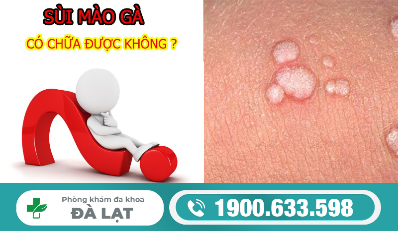 BỆNH SÙI MÀO GÀ Ở DÂY HÃM (DÂY THẮNG BAO QUY ĐẦU) 