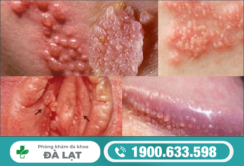 Bệnh sùi mào gà ở đầu khấc: Nguyên nhân, dấu hiệu và cách chữa trị hiệu quả 