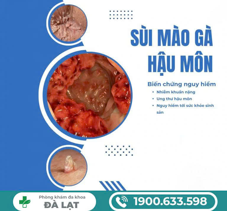SÙI MÀO GÀ Ở HẬU MÔN NAM GIỚI: TRIỆU CHỨNG – NGUYÊN NHÂN – CÁCH CHỮA 