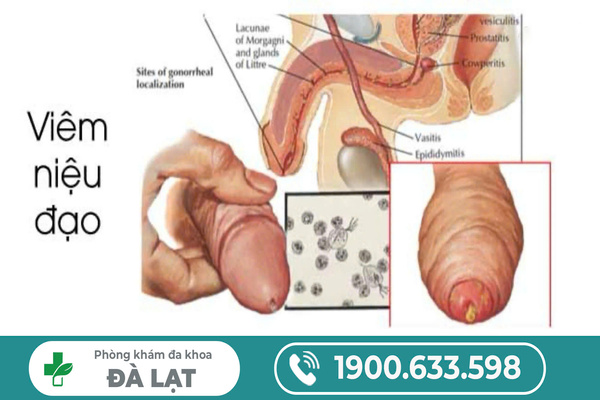 VIÊM NIỆU ĐẠO Ở NAM GIỚI LÀ GÌ? NGUYÊN NHÂN VÀ CÁCH ĐIỀU TRỊ HIỆU QUẢ 