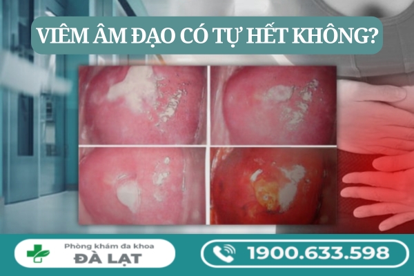 Bị Viêm Âm Đạo Có Tự Hết Không? 