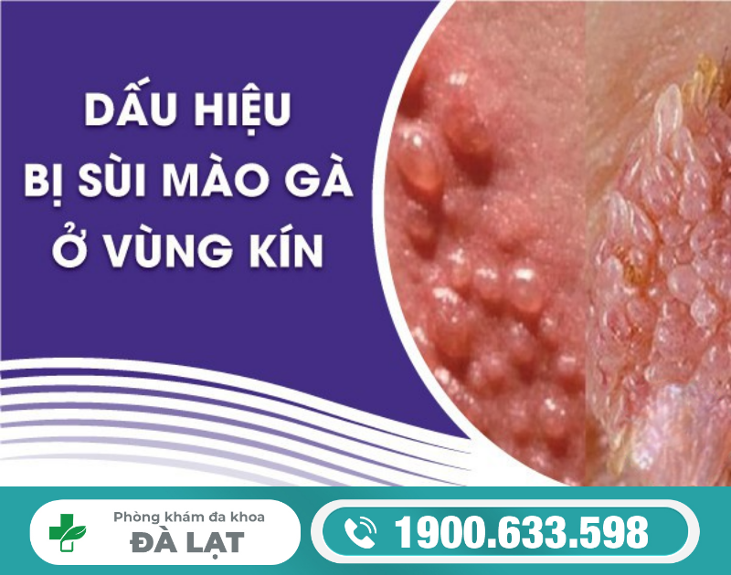 BỆNH SÙI MÀO GÀ Ở CỔ TỬ CUNG – NGUYÊN NHÂN, TRIỆU CHỨNG, MỨC ĐỘ NGUY HIỂM VÀ CÁCH ĐIỀU TRỊ 