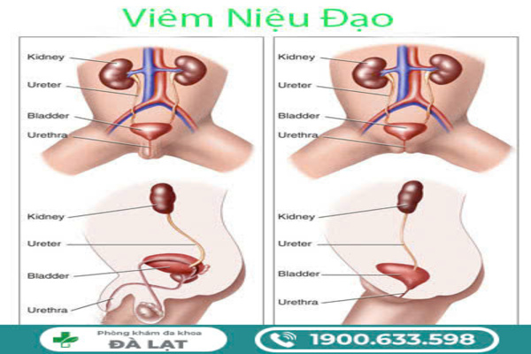 CÁC NGUYÊN NHÂN KHIẾN NAM VÀ NỮ DỄ BỊ VIÊM NIỆU ĐẠO 