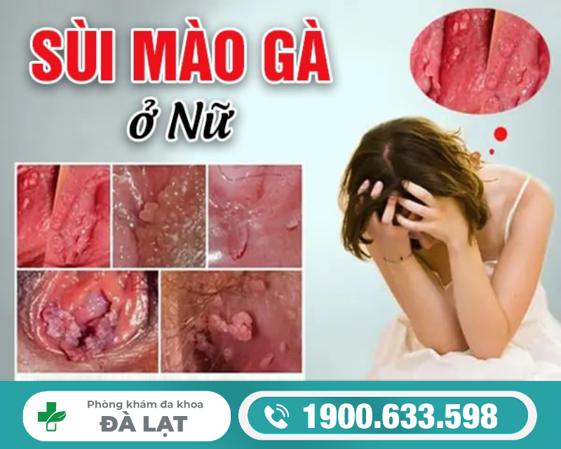 BỆNH SÙI MÀO GÀ Ở LỖ NIỆU ĐẠO NỮ: NGUYÊN NHÂN – DẤU HIỆU – MỨC ĐỘ NGUY HIỂM VÀ CÁCH ĐIỀU TRỊ HIỆU QUẢ 