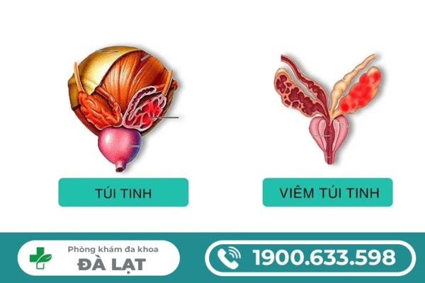 CHỮA VIÊM TÚI TINH Ở NAM GIỚI: PHƯƠNG PHÁP ĐIỀU TRỊ HIỆU QUẢ HIỆN NAY 