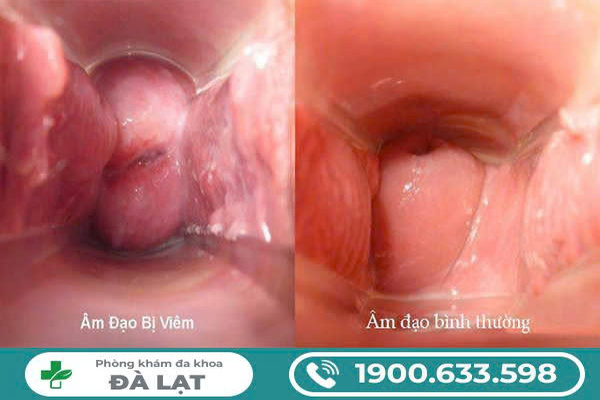 Hình Ảnh, Biểu Hiện Của Viêm Âm Đạo 