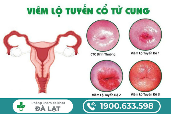 Chưa Quan Hệ Có Thể Bị Viêm Lộ Tuyến Cổ Tử Cung Không? 