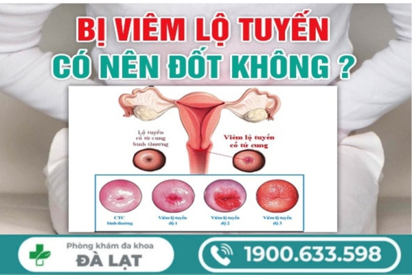Bị Viêm Lộ Tuyến Cổ Tử Cung Có Cần Đốt Không? 