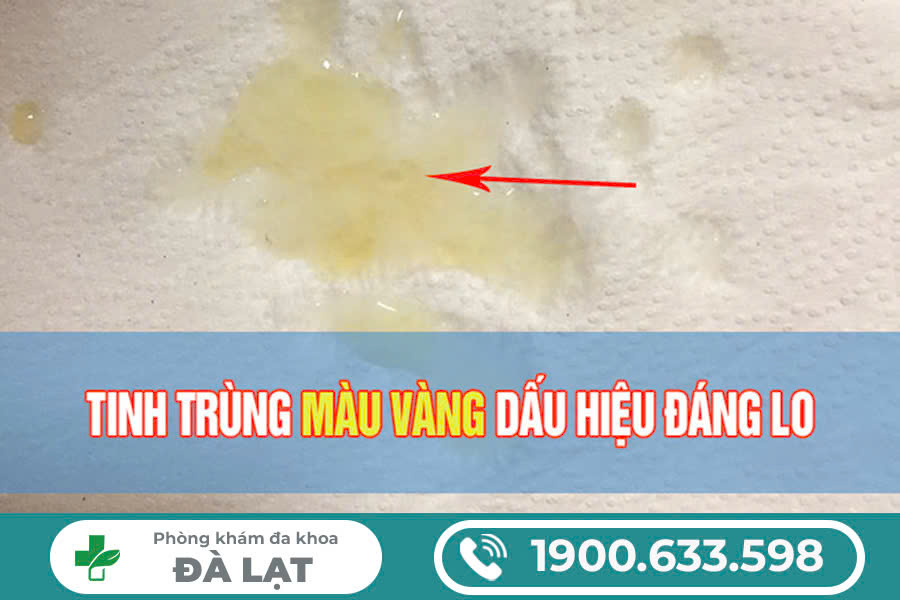 CÁCH CHỮA TINH TRÙNG MÀU VÀNG Ở NAM GIỚI HIỆU QUẢ HIỆN NAY 