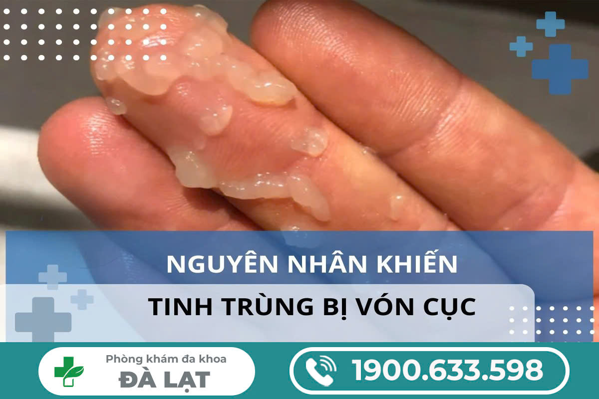 TẠI SAO TINH TRÙNG VÓN CỤC Ở NAM GIỚI? BÁC SĨ CHUYÊN KHOA GIẢI ĐÁP