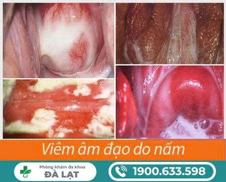 Hình Ảnh Nấm Phụ Khoa 