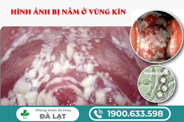 Nấm Phụ Khoa Tái Phát Nhiều Lần 