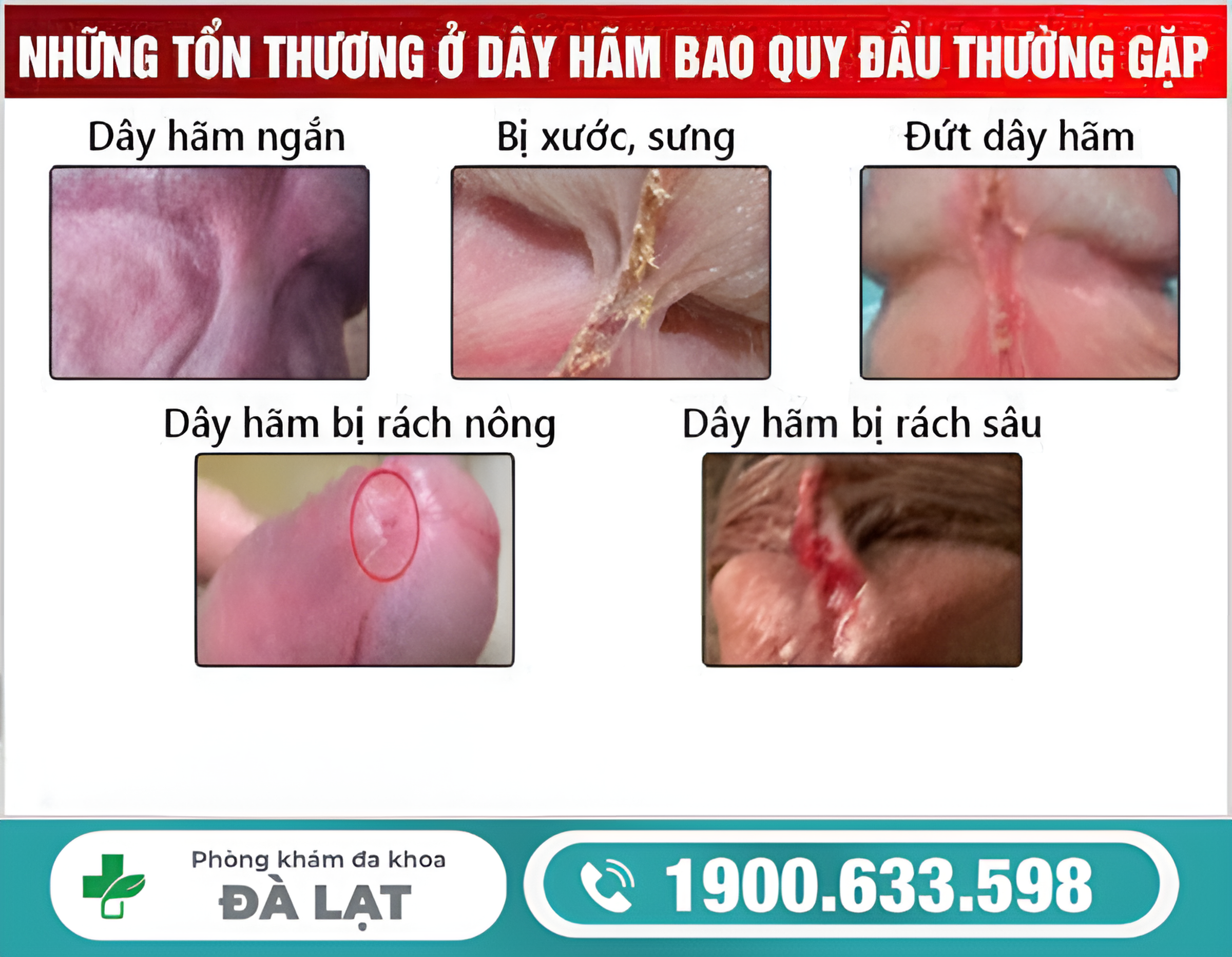 ĐỨT DÂY HÃM BAO QUY ĐẦU CÓ NGUY HIỂM KHÔNG? BÁC SĨ CHUYÊN KHOA GIẢI ĐÁP 