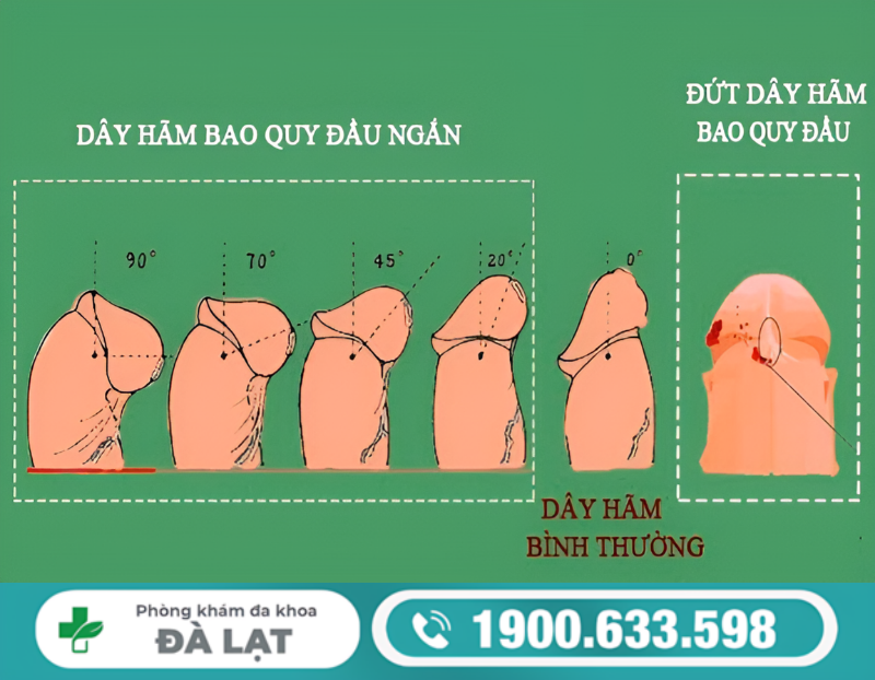 DÂY THẮNG DƯƠNG VẬT BỊ ĐỨT CÓ NGUY HIỂM KHÔNG? BÁC SĨ GIẢI ĐÁP CHI TIẾT 