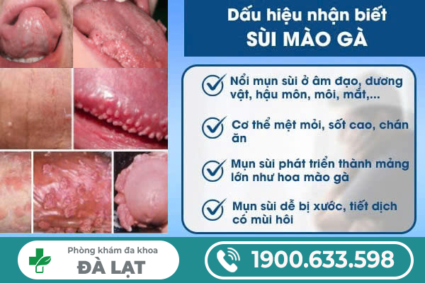 CÁCH CHỮA BỆNH SÙI MÀO GÀ Ở NAM GIỚI 
