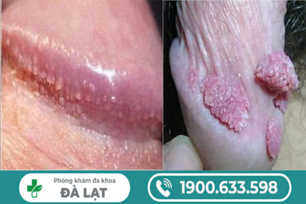 BIỂU HIỆN BỆNH SÙI MÀO GÀ Ở NAM GIỚI 