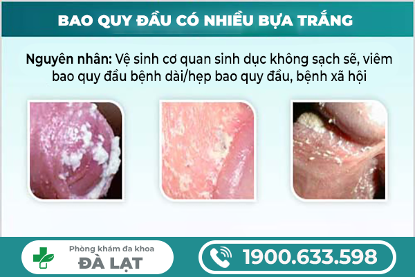 NGUYÊN NHÂN PHỔ BIẾN KHIẾN BỰA SINH DỤC Ở NAM GIỚI 