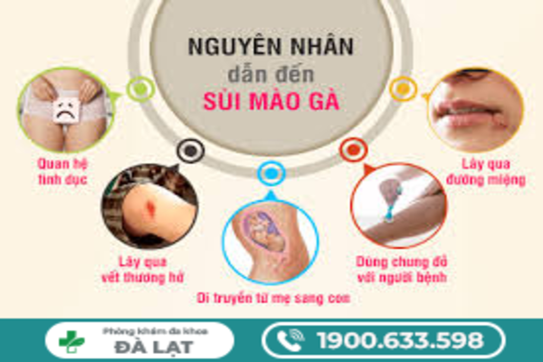    Bệnh sùi mào gà giai đoạn đầu ở nam giới
