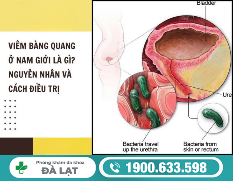 VIÊM BÀNG QUANG DẪN ĐẾN BIẾN CHỨNG GÌ? DẤU HIỆU NHẬN BIẾT SỚM