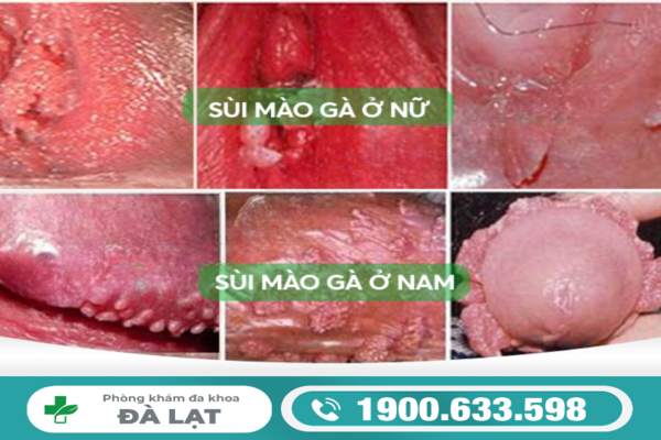 CÁCH CHỮA BỆNH SÙI MÀO GÀ Ở NỮ GIỚI  