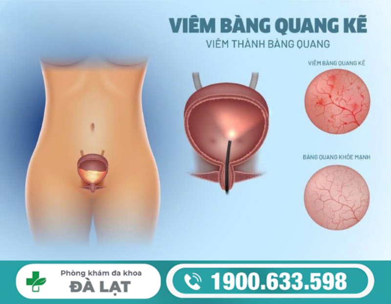 BỆNH VIÊM BÀNG QUANG KẼ Ở NAM GIỚI: DẤU HIỆU NHẬN BIẾT VÀ CÁCH ĐIỀU TRỊ 