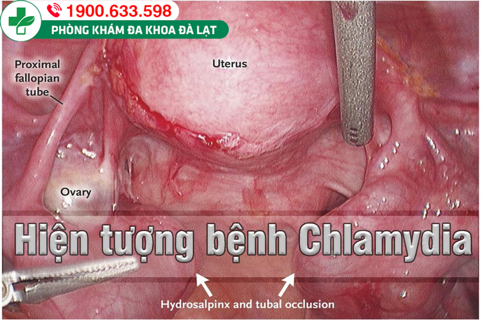 THỜI GIAN Ủ BỆNH CHLAMYDIA LÀ BAO LÂU? 