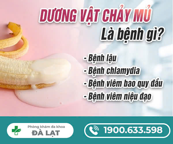DƯƠNG VẬT CHẢY MỦ Ở NAM GIỚI LÀ BỆNH GÌ? DẤU HIỆU NHẬN BIẾT 