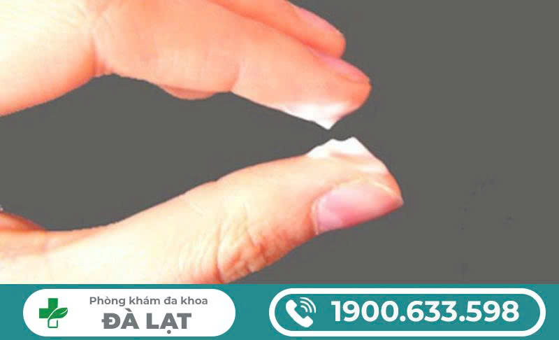 Ra Khí Hư Màu Trắng Như Bã Đậu: Nguyên Nhân, Biểu Hiện, Triệu Chứng và Biến Chứng 