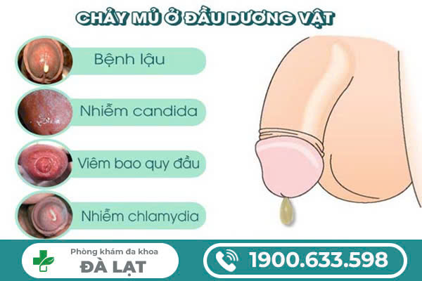 DƯƠNG VẬT CHẢY MỦ KÈM ĐAU BUỐT: DẤU HIỆU BỆNH NAM KHOA NGUY HIỂM 