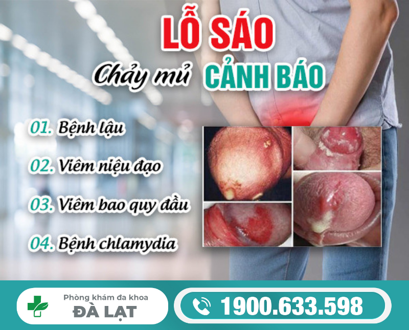 BAO QUY ĐẦU CHẢY MỦ LÀ BỆNH GÌ? NHỮNG BIẾN CHỨNG NGUY HIỂM CẦN BIẾT