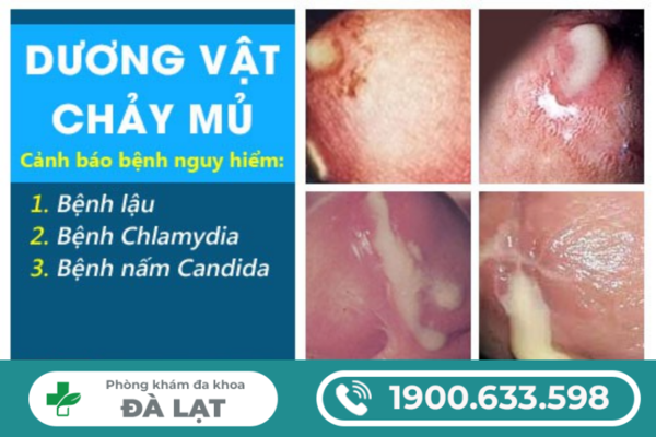 GIỌT MỦ BAN MAI: DẤU HIỆU BỆNH LÝ NAM KHOA NGUY HIỂM 